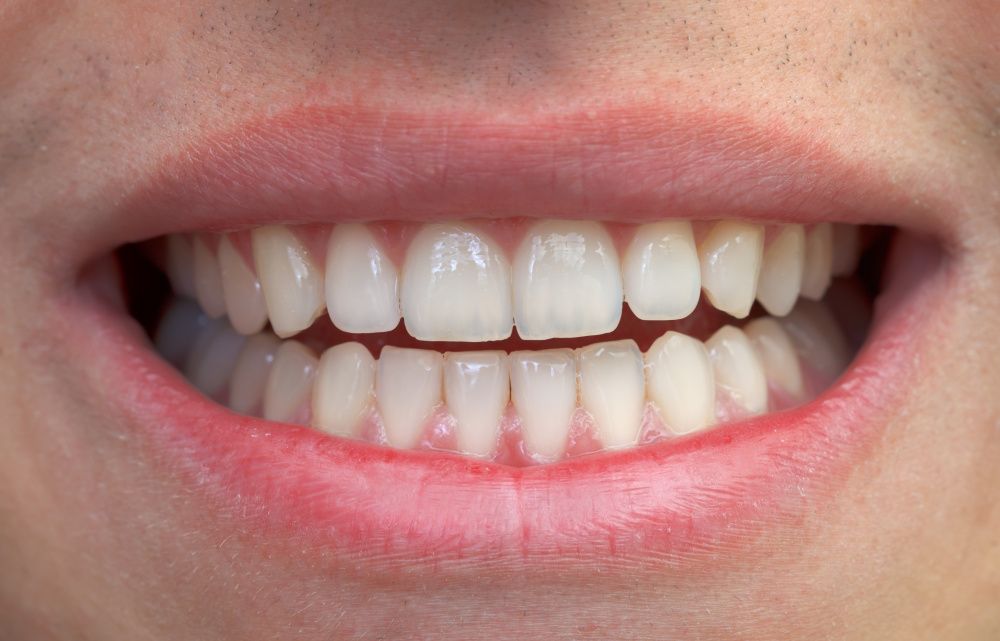 Восстановление зуба с помощью балочного протеза